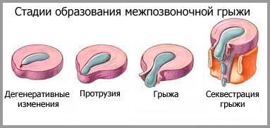 Межпозвоночная грыжа